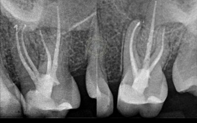 CASE STUDY: A challenging second molar with 4 canals