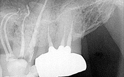 Coronal Minimally Invasive Access：歯冠部のアクセスが大変限られたケース.25/03と30/05使用