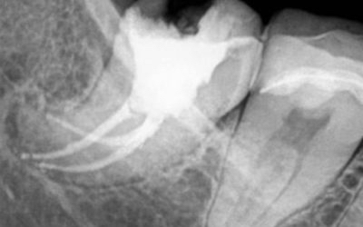 Minimal Invasive Coronal Access：歯冠部へのアクセスが大変限られたケース